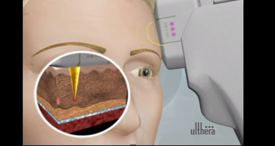 Face lift with Ulthera by SLC clinic