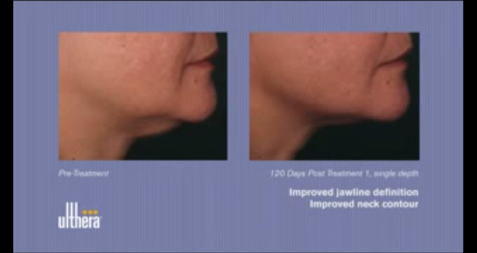 Non-surgical face lift with Ulthera by SLC clinic