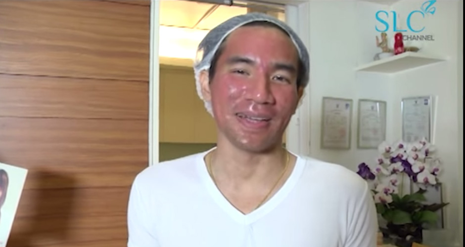 Beauty Magic Season 3 Ep.11 ธรรม/ Fraxel + Subcision (12 พฤษภาคม 2556)