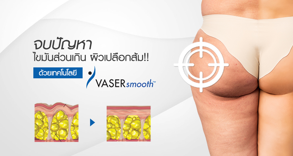 Eliminate excess fat and cellulite or “orange peel skin” with “Vaser Smooth”