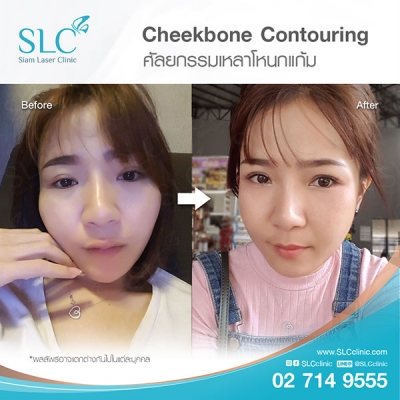 SLC Clinic - เหลาโหนกแก้ม 03