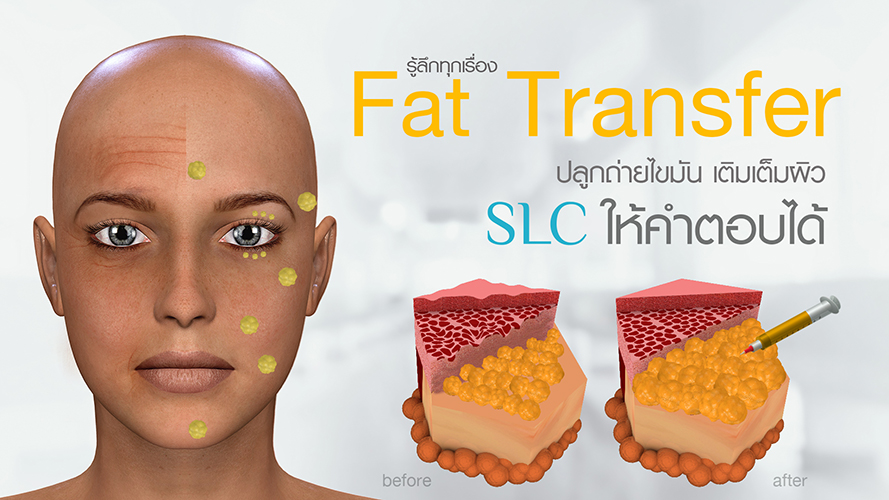 รู้ลึก เรื่องปลูกถ่ายไขมัน หน้าเด็ก FAT TRANSFER เติมเต็มผิว