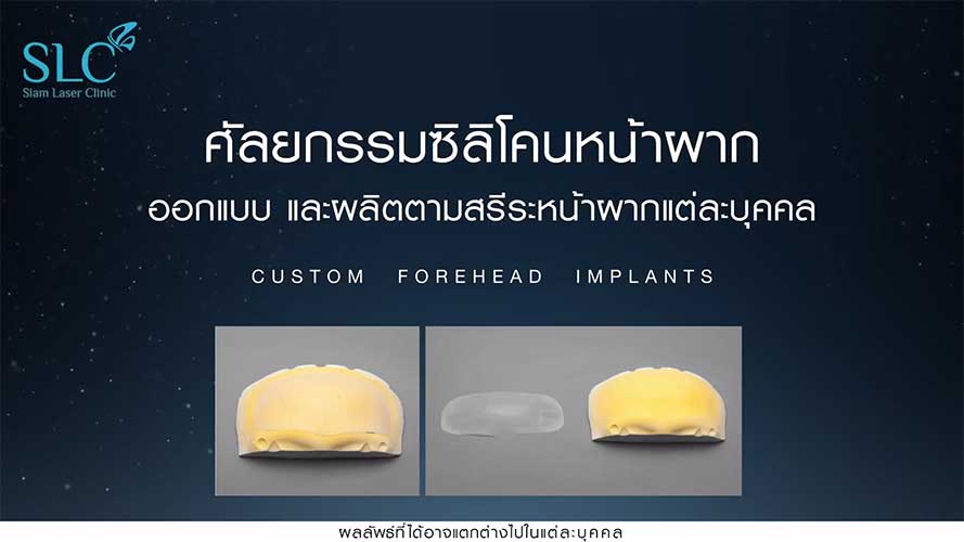 Custom Forehead Implants ศัลยกรรมเสริมหน้าผาก