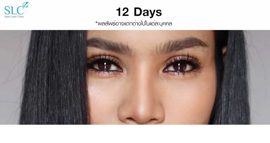 ศัลยกรรมตาสองชั้น| รีวิวตาสองชั้น จากคุณ ออย Chila Makeup Artist