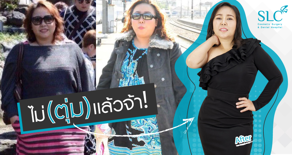 รีวิว ตัดหนังหน้าท้อง แก้ปัญหา หน้าท้อง “หย่อน คล้อย ไม่กระชับ”