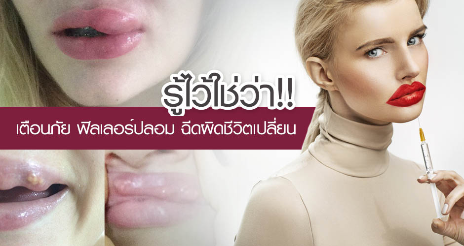 สวยไม่เสี่ยง! ฉีดฟิลเลอร์ปลอดภัย ไร้ของปลอม!