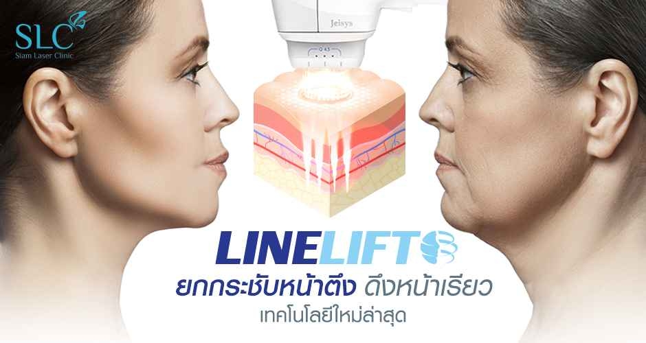 โปรแกรม Linelift ยกผิวตึง ดึงผิวกระชับ โดยไม่ต้องผ่าตัด 