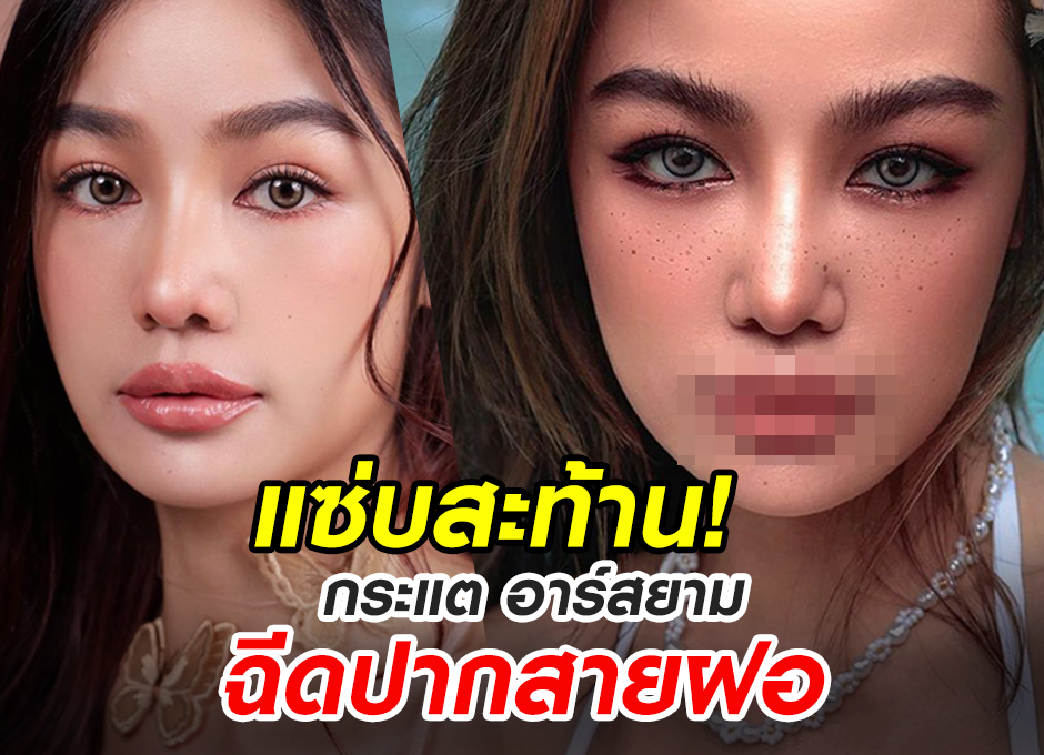 So sassy! Kratae RSiam has Filler Injection to get the mouth of beauty!