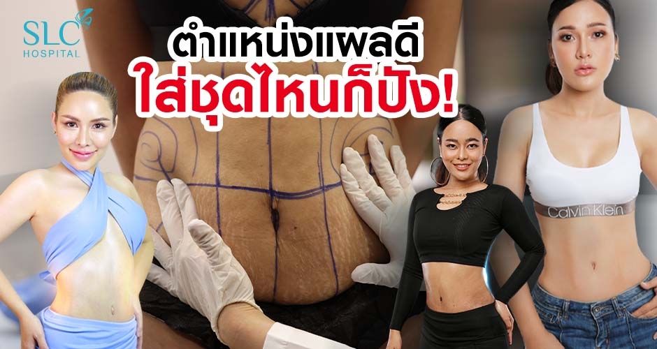 การแต่งกายมีผลต่อ การวางตำแหน่งแผล หลังผ่าตัดหน้าท้องแบบ Tummy Tuck