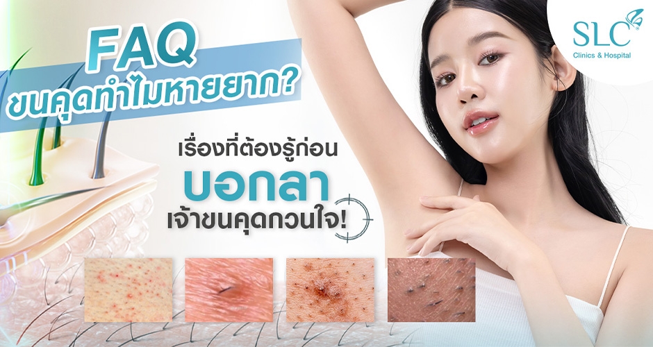 FAQ เลเซอร์ขนคุด เรื่องที่ ต้องรู้ ก่อนบอกลาเจ้าขนคุดกวนใจ!