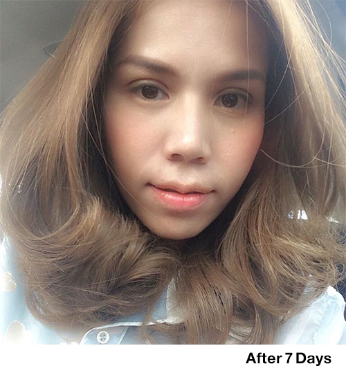 หลังทำศัลยกรรม 7 วัน